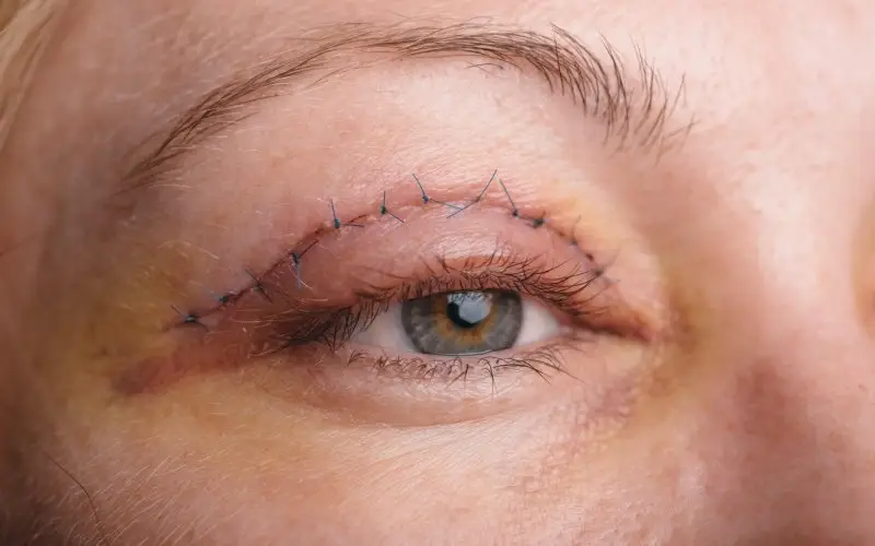 بخیه جراحی پلک