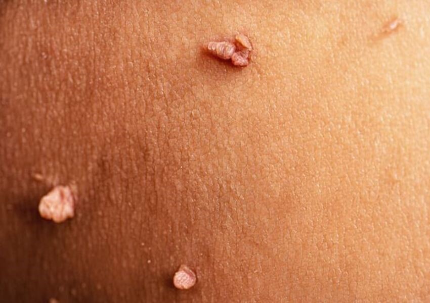 زگیل تناسلی چیست _3