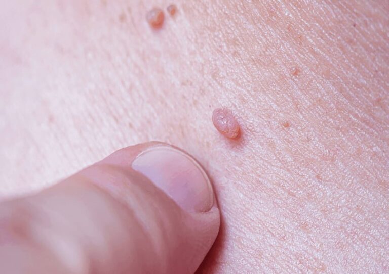 علت زگیل تناسلی چیست؟ _1