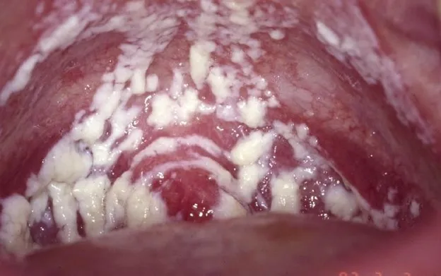 تصویر عفونت قارچی واژن